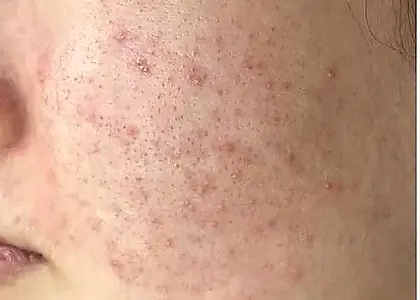 Recurring Acne skin concern