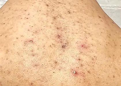 Body Congestion skin concern