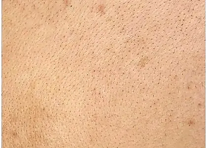 Uneven Body Texture skin concern